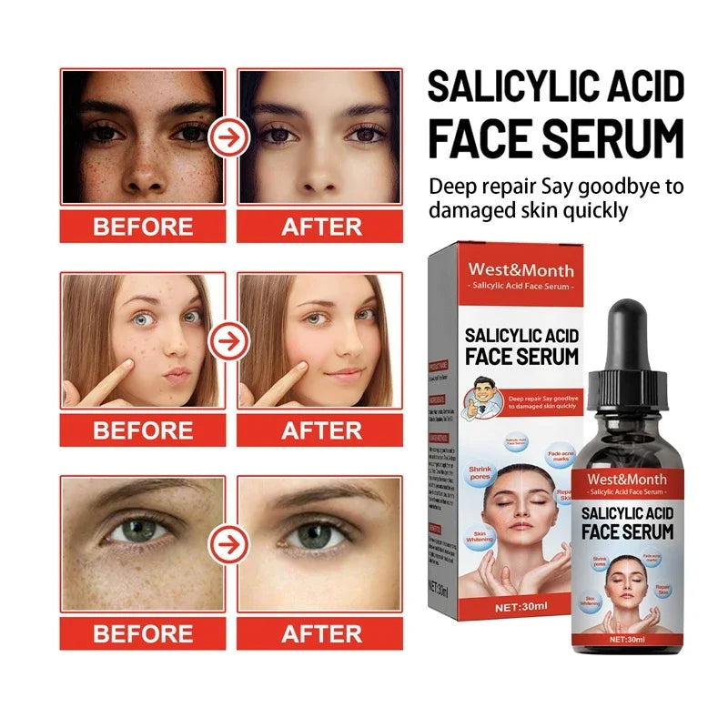 Nicotinamide Attenuates Stains Facial Serum Salicylic Acid Shrinks Pores Freckle Removal Moisturizes Face Skin Care Serum 2024