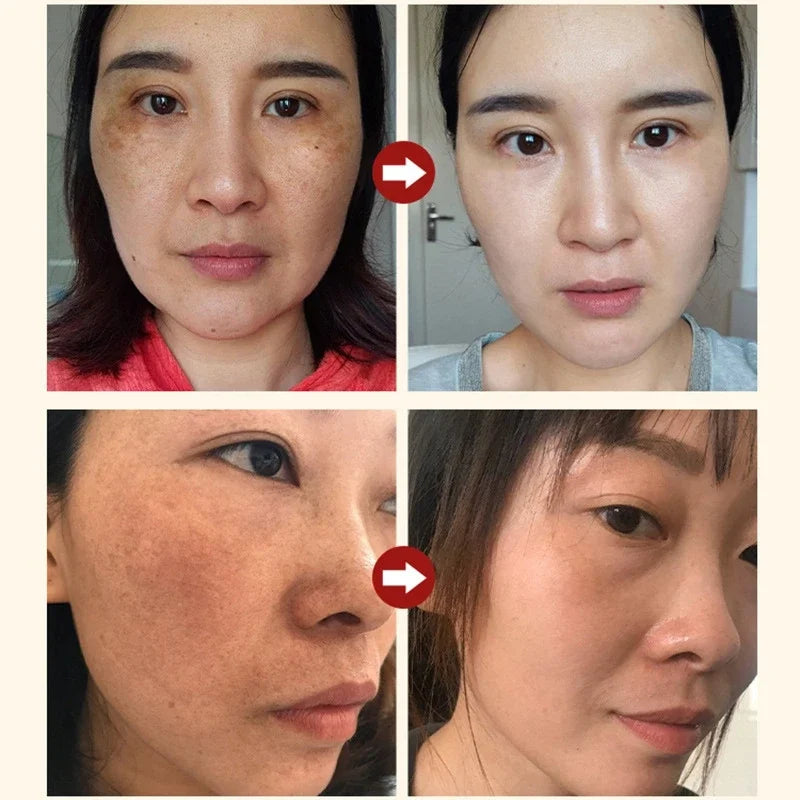 Nicotinamide Attenuates Stains Facial Serum Salicylic Acid Shrinks Pores Freckle Removal Moisturizes Face Skin Care Serum 2024