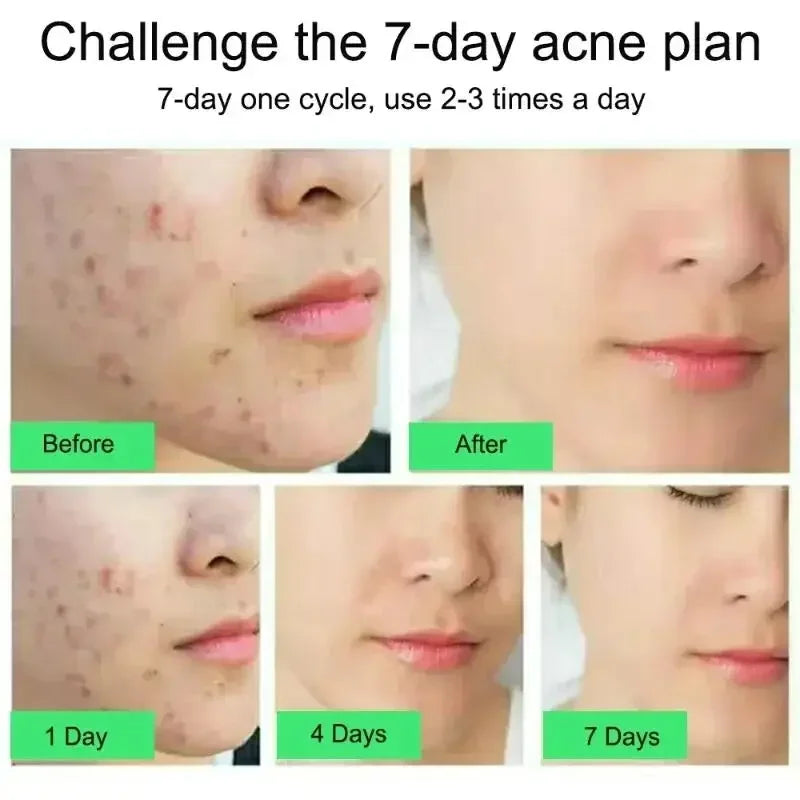 Tea Tree Acne Removal Serum Repair Pimple Spots Shrinking Pore Remove Blackheads Facial Cleaning Fade Acne Marks Whitening Skin