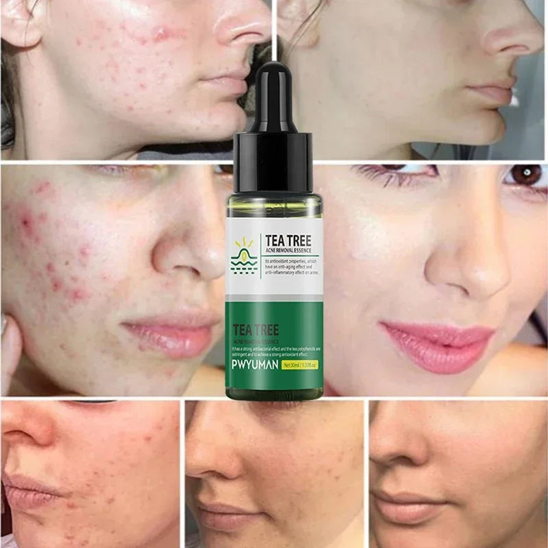 Tea Tree Acne Removal Serum Repair Pimple Spots Shrinking Pore Remove Blackheads Facial Cleaning Fade Acne Marks Whitening Skin