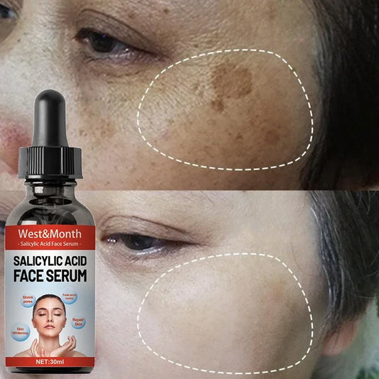 Nicotinamide Attenuates Stains Facial Serum Salicylic Acid Shrinks Pores Freckle Removal Moisturizes Face Skin Care Serum 2024