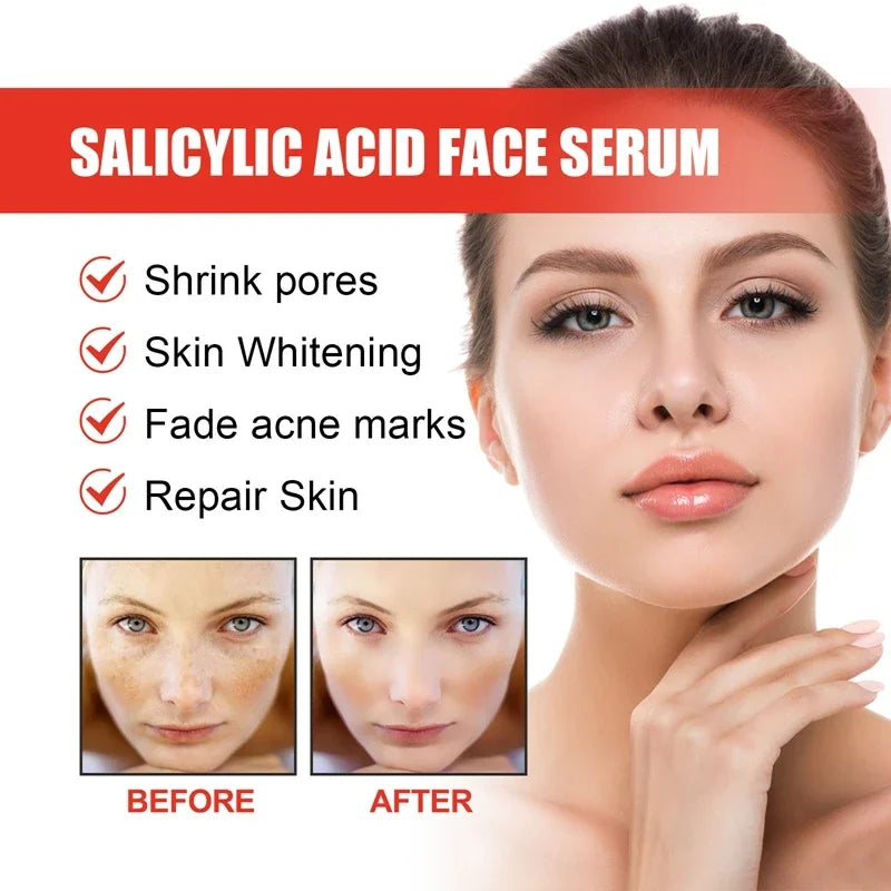 Nicotinamide Attenuates Stains Facial Serum Salicylic Acid Shrinks Pores Freckle Removal Moisturizes Face Skin Care Serum 2024