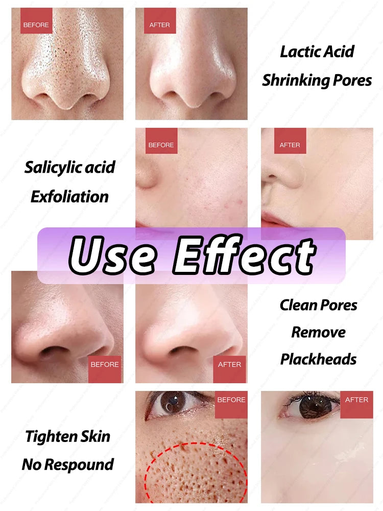 Solve big pores problems